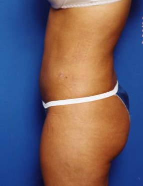 Woman's body, after Liposuction treatment, l-side view, patient 14
