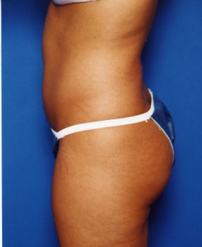 Woman's body, before Liposuction treatment, l-side view, patient 14