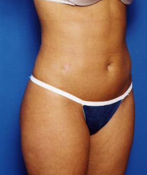 Woman's body, after Liposuction treatment, r-side oblique view, patient 14