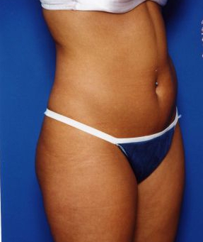 Woman's body, before Liposuction treatment, r-side oblique view, patient 14