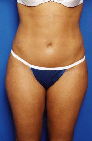 Woman's body, after Liposuction treatment, front view, patient 14