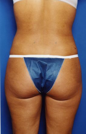 Woman's body, after Liposuction treatment, b-side view, patient 14