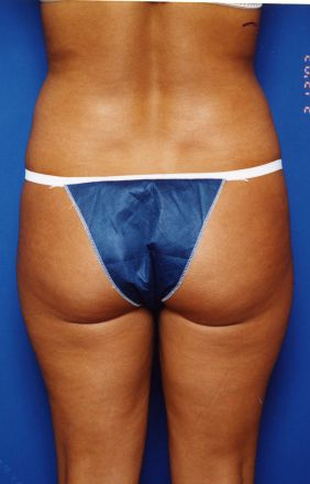 Woman's body, before Liposuction treatment, b-side view, patient 14