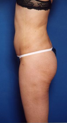 Woman's body, after Liposuction treatment, l-side view, patient 15