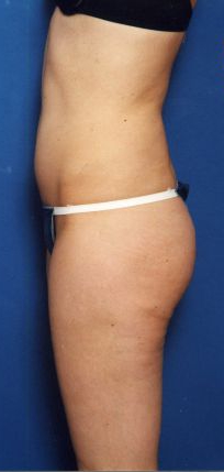 Woman's body, before Liposuction treatment, l-side view, patient 15