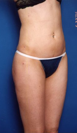 Woman's body, after Liposuction treatment, r-side oblique view, patient 15