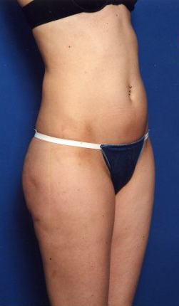 Woman's body, before Liposuction treatment, r-side oblique view, patient 15