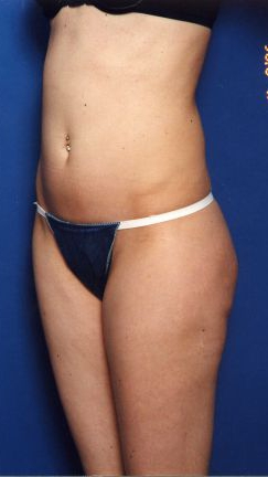 Woman's body, before Liposuction treatment, l-side oblique view, patient 15
