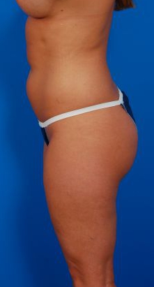 Woman's body, before Liposuction treatment, l-side view, patient 16