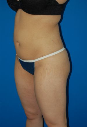 Woman's body, after Liposuction treatment, l-side oblique view, patient 49