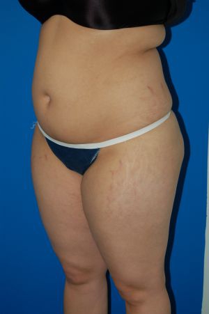 Woman's body, before Liposuction treatment, l-side oblique view, patient 49