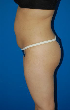 Woman's body, after Liposuction treatment, l-side view, patient 49