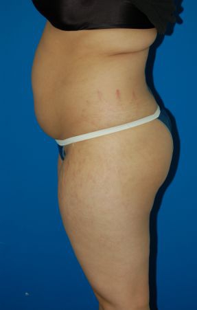 Woman's body, before Liposuction treatment, l-side view, patient 49