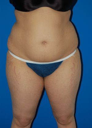 Woman's body, before Liposuction treatment, front view, patient 49
