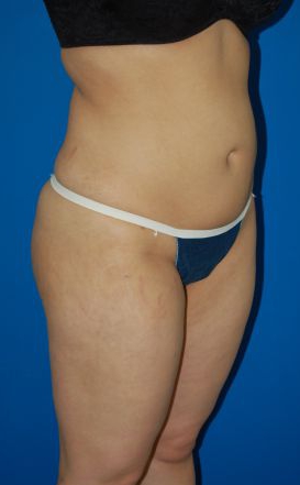 Woman's body, after Liposuction treatment, r-side oblique view, patient 49