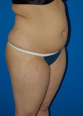 Woman's body, befor Liposuction treatment, r-side oblique view, patient 49