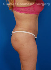 Woman's body, after Liposuction treatment, r-side view, patient 2