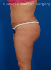 Liposuction Photos Case 2 after side left view