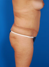 Woman's body, before Liposuction treatment, r-side view, patient 2