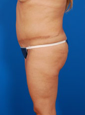 Woman's body, before C-Section Scar Removal treatment, l-side view, patient 2