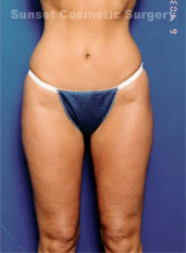 Woman's body, after Liposuction treatment, front view, patient 4