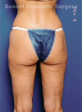 Woman's body, after Liposuction treatment, b-side view, patient 4