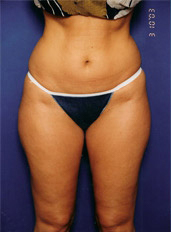 Woman's body, before Liposuction treatment, front view, patient 4