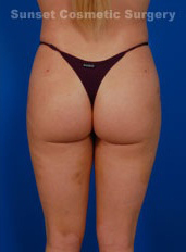 Woman's body, after Liposuction treatment, b-side view, patient 5