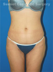 Woman's body, after Liposuction treatment, front view, patient 6