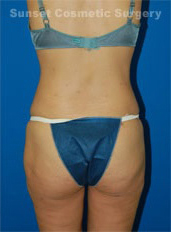 Woman's body, after Liposuction treatment, b-side view, patient 6