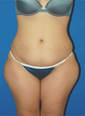 Woman's body, before Liposuction treatment, front view, patient 6