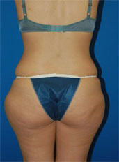 Woman's body, before Liposuction treatment, b-side view, patient 6