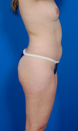 Woman's body, before Liposuction treatment, r-side view, patient 7