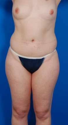 Woman's body, before Liposuction treatment, front view, patient 7