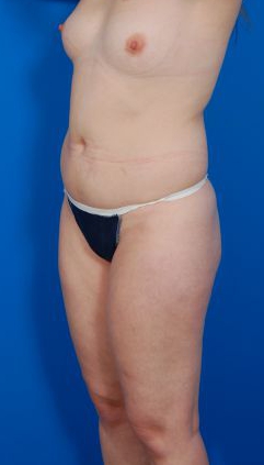 Woman's body, before Liposuction treatment, l-side oblique view, patient 7