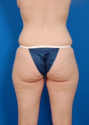 Woman's body, before Liposuction treatment, b-side view, patient 8