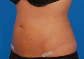 Woman's body, after Liposuction treatment, l-side oblique view, patient 9