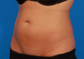 Woman's body, before Liposuction treatment, l-side oblique view, patient 9