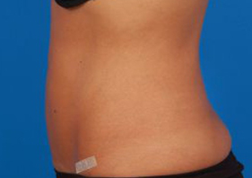 Woman's body, after Liposuction treatment, l-side view, patient 9