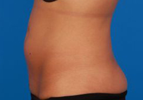 Woman's body, before Liposuction treatment, l-side view, patient 9