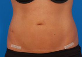 Woman's body, after Liposuction treatment, front view, patient 9