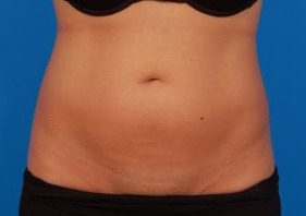 Woman's body, before Liposuction treatment, front view, patient 9