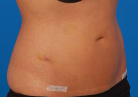 Woman's body, after Liposuction treatment, r-side oblique view, patient 9