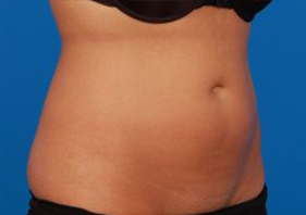 Woman's body, before Liposuction treatment, r-side oblique view, patient 9