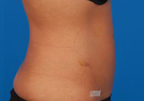 Woman's body, after Liposuction treatment, r-side view, patient 9