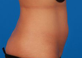 Woman's body, before Liposuction treatment, r-side view, patient 9