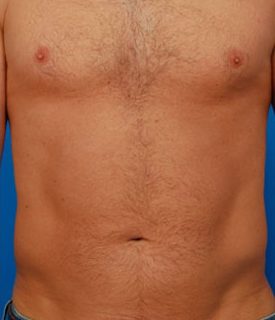Male Belly Button Surgery Photos Case 3 after frontal view