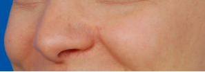 Woman's face, after Mole Removal treatment, l-side oblique view, patient 1