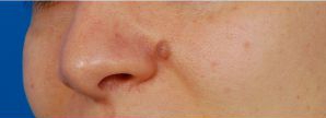 Woman's face, before Mole Removal treatment, l-side oblique view, patient 1