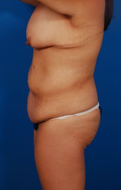 Woman's body, before Mommy Makeover treatment, l-side view, patient 1
